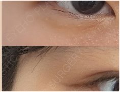 쌍꺼풀 수술 가격 및 후기 비교 분석 관련 이미지 20