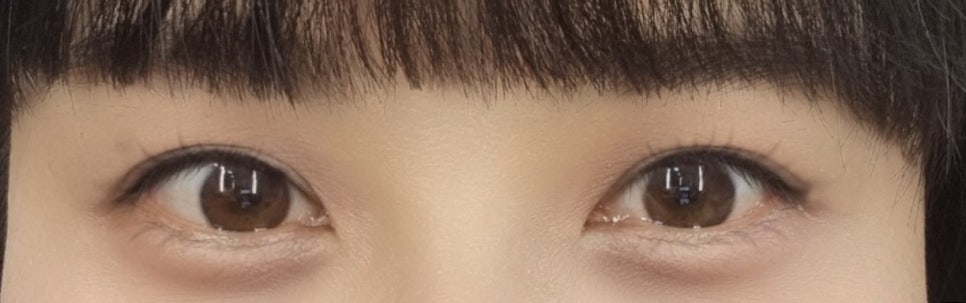 쌍꺼풀수술전후 다양한 방식을 체크하여 관련 이미지 16