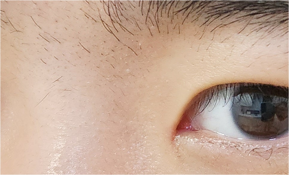 Effectively Achieving a Natural Look with Male Eye Surgery image 19