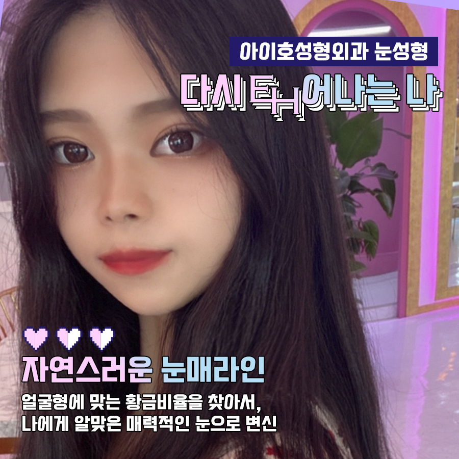 눈성형전후 디테일까지 꼼꼼하게 비교 관련 이미지 5