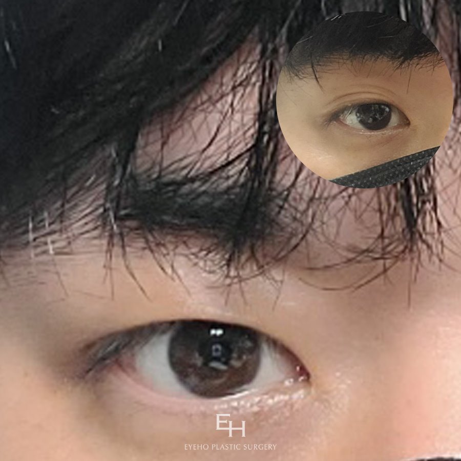 남자눈성형가격 현혹되지 말고 남자눈성형잘하는곳 찾아야 관련 이미지 6