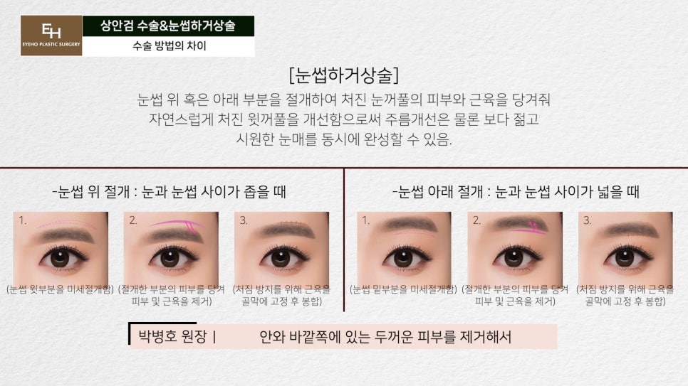 처진눈 상안검? 눈썹하거상술? 궁금하시다면 들어와!! 관련 이미지 26