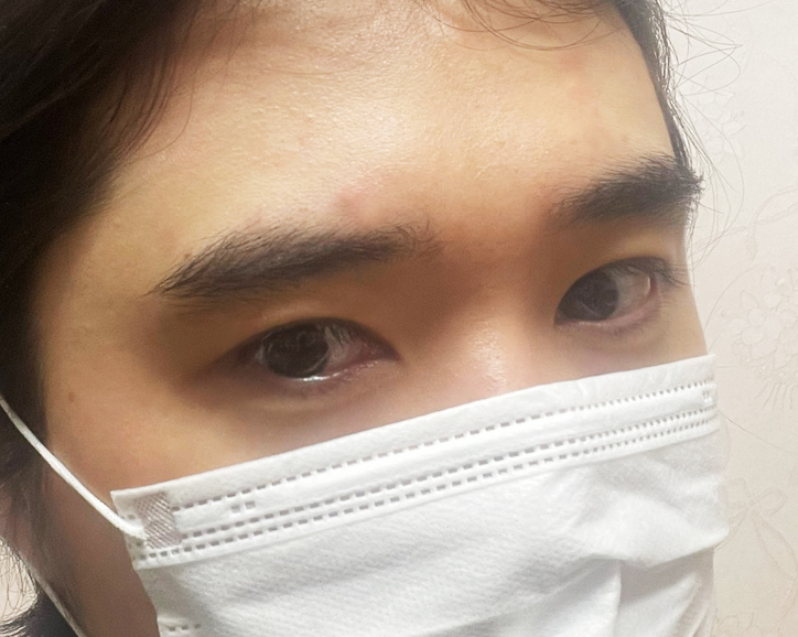 Carefully Compare Before and After Male Eye Correction image 15