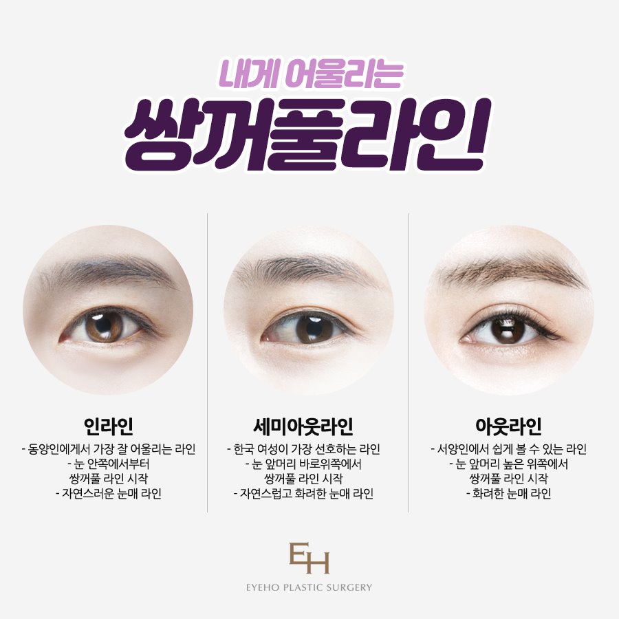 쌍꺼풀 수술 매몰 및 쌍꺼풀수술후기 / 쌍꺼풀 수술 병원 비교 관련 이미지 3