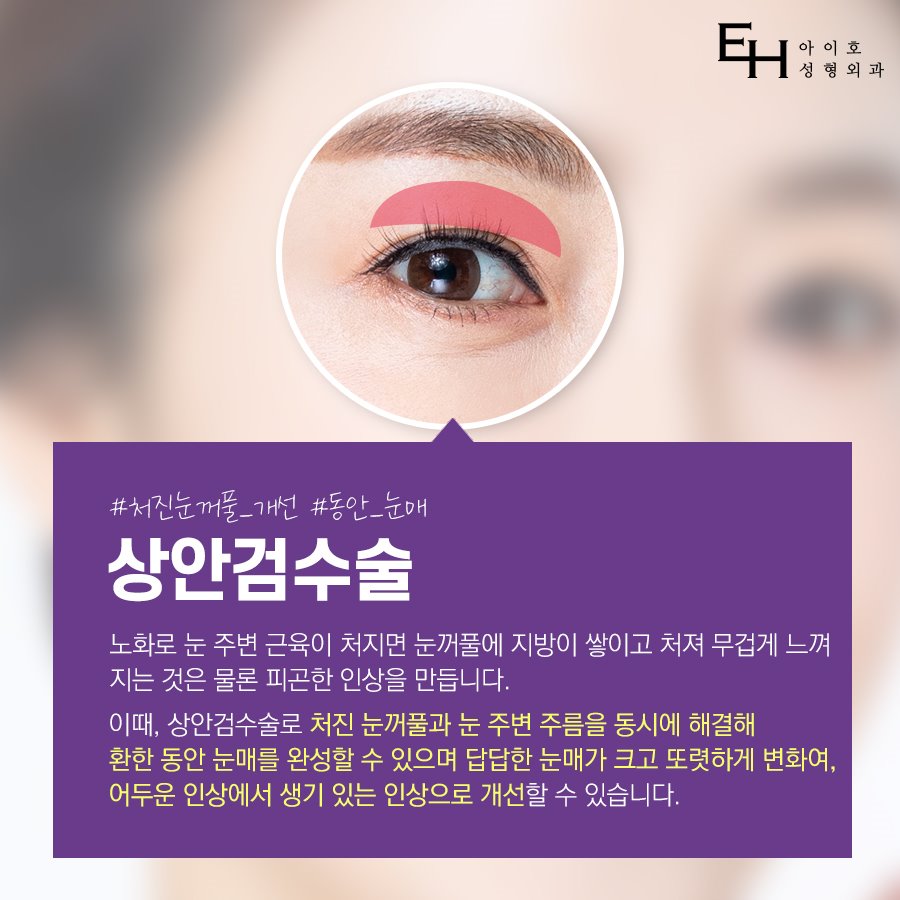 상안검수술가격 부작용 없이 회복기간 위하여 관련 이미지 2