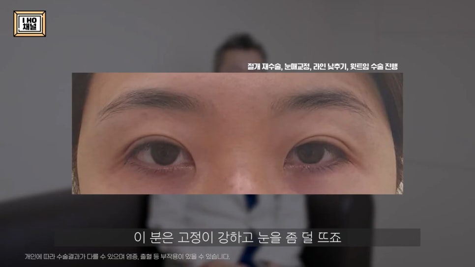 소세지눈 다 같은 게 아니다!? 유형별 재수술 방법에 대해 알려드리겠습니다. 관련 이미지 56