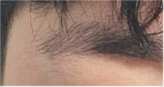 눈성형 종류 : 남자 눈성형 수술 후기 확인 관련 이미지 18
