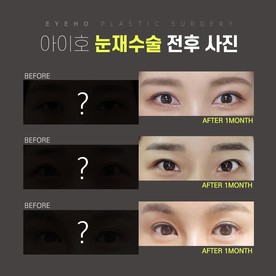 눈재수술비용 어떨때 개선해야 하나요? 관련 이미지 6