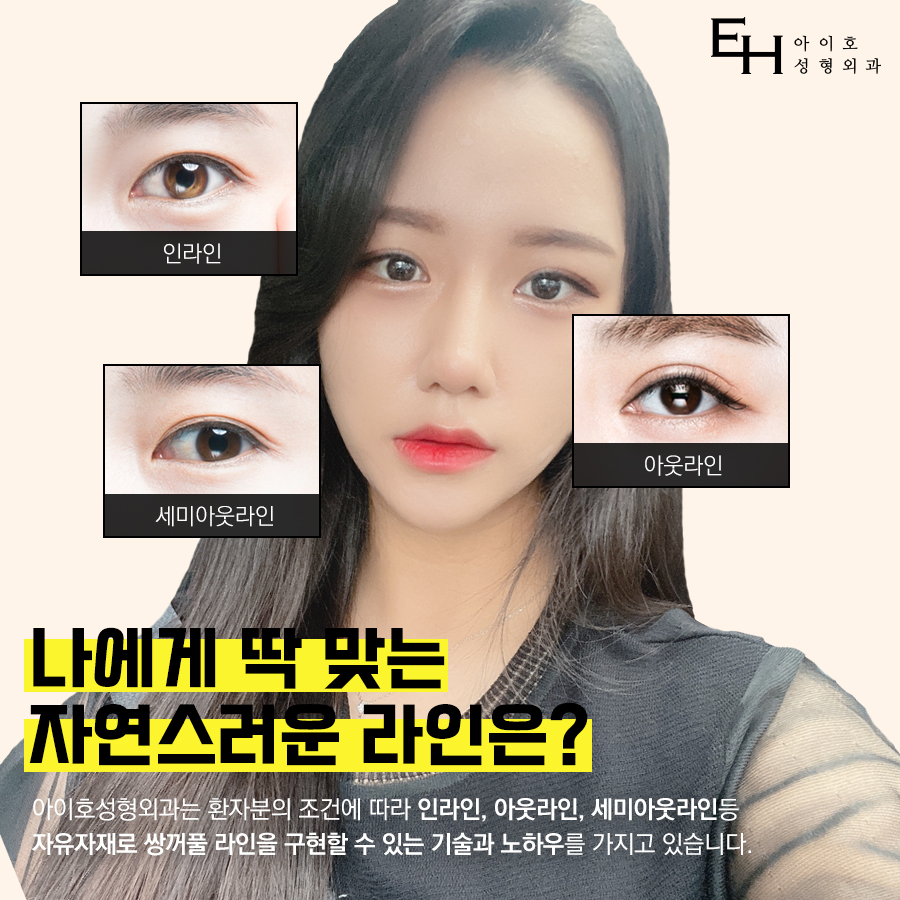 눈성형전후 디테일까지 꼼꼼하게 비교 관련 이미지 3