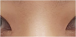 상안검 수술 후기 : 상안검수술비용 그리고 회복기간 관련 이미지 20