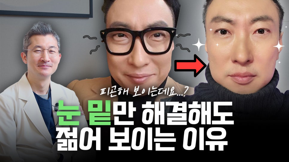 눈밑지방재배치 VS 하안검 수술 차이점은? 관련 이미지 57