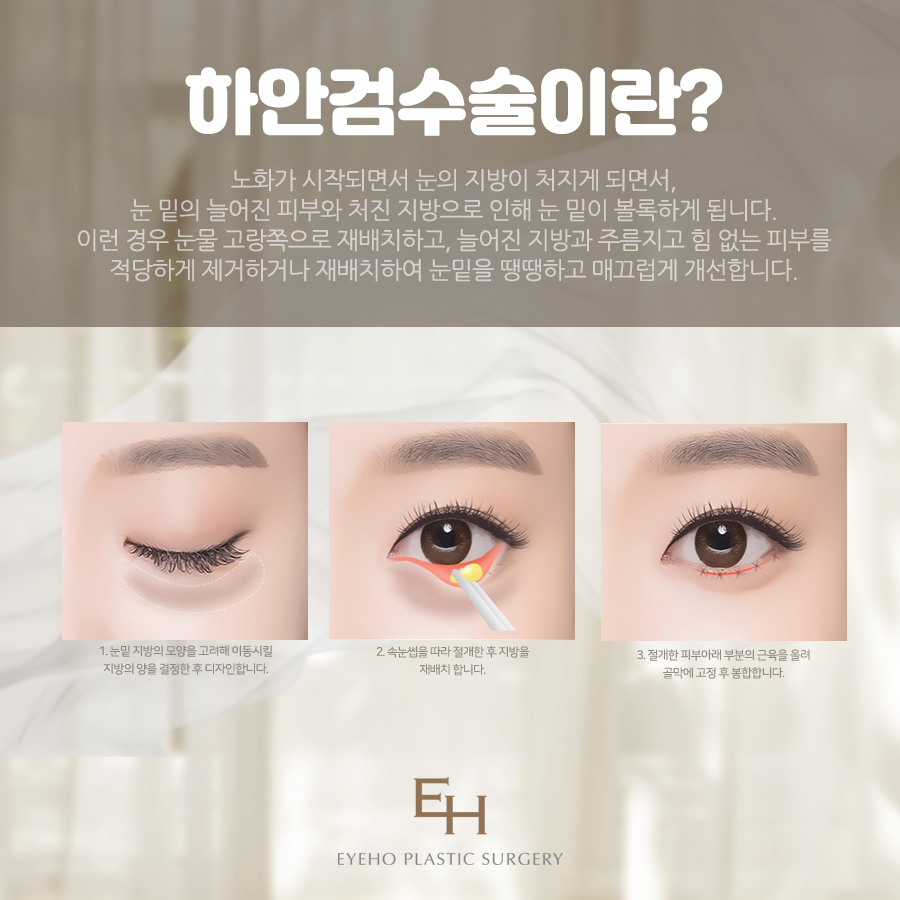 중년눈성형 종류 나에게 맞는 올바른 수술 방법 관련 이미지 4