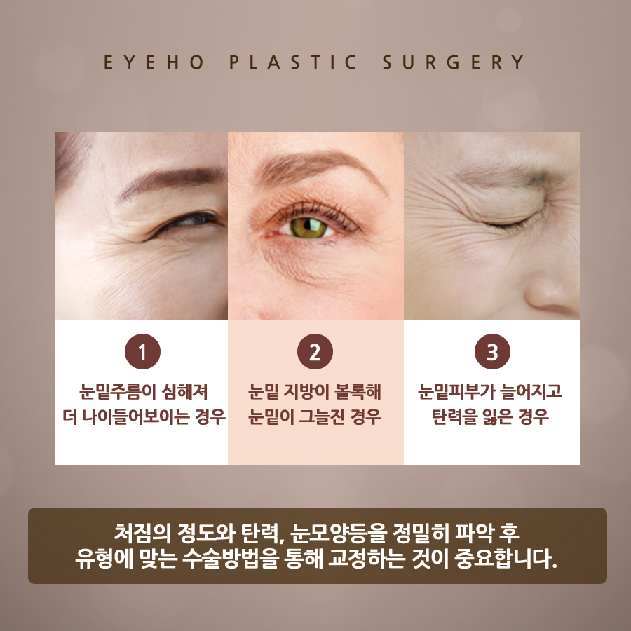 하안검 수술 후기 : 눈 밑 하안검 흉터 & 통증 / 잘하는곳 비교 분석 관련 이미지 5