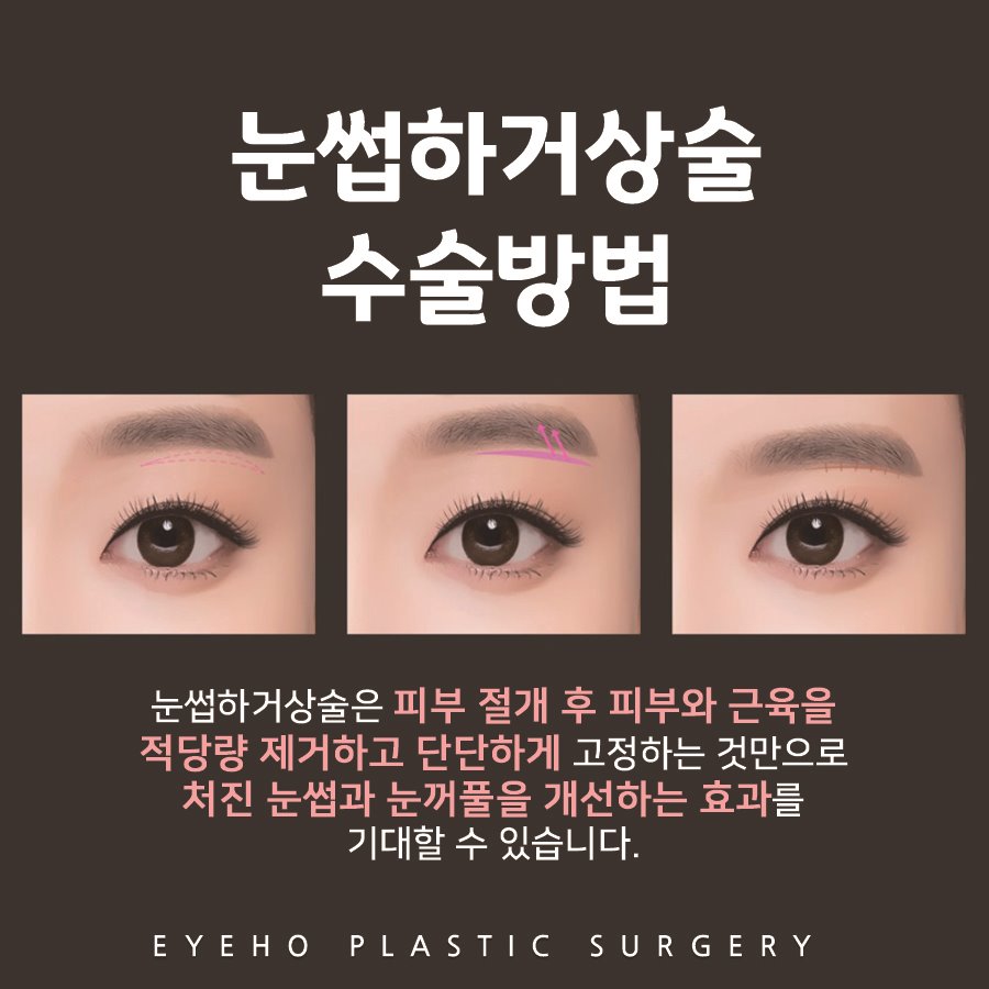Review of Brow Lift Surgery: Increasing Satisfaction with Scars image 3