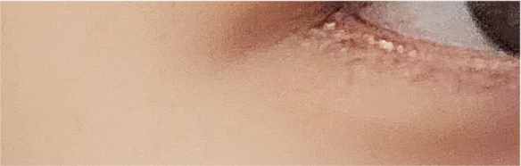 쌍수매몰법 매력적인 나만의 라인으로 관련 이미지 24