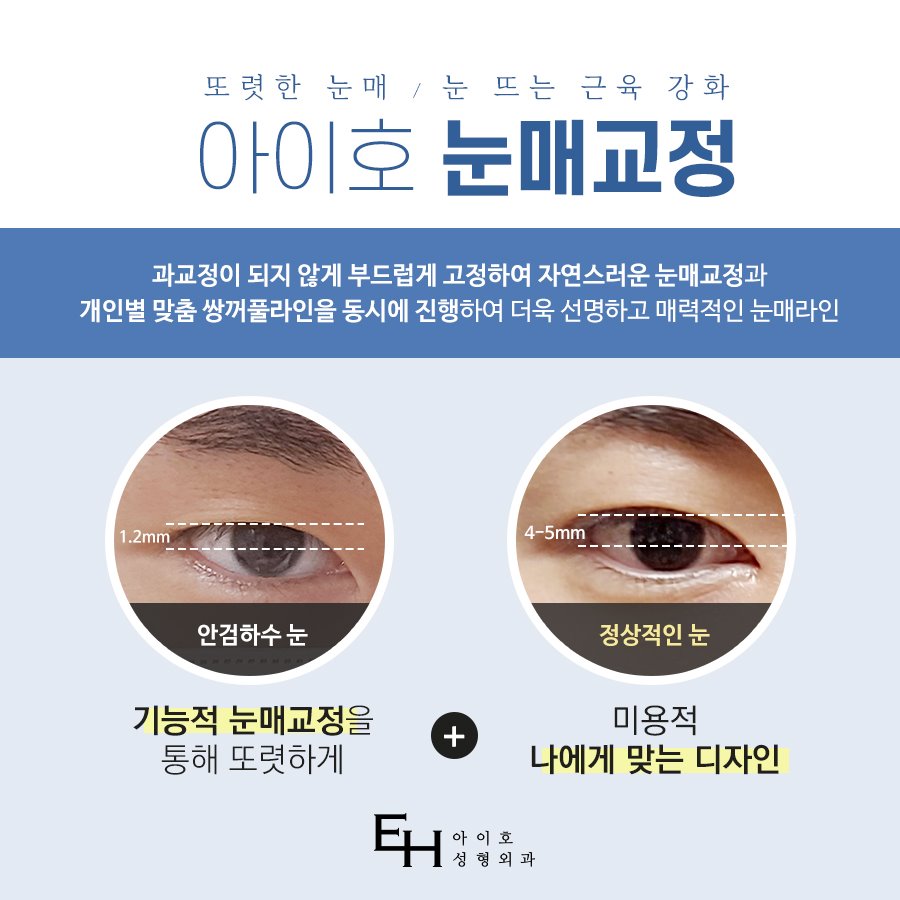 Male Eye Correction Surgery Should Be Tailored to the Individual Face image 3