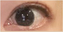 Changed Appearance Before and After Eye Revision Surgery image 38