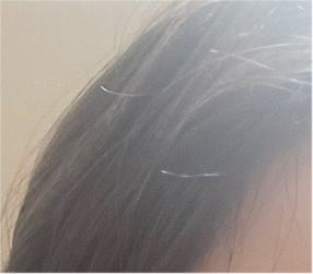 남자 눈매교정 가격 및 남자 눈매교정 전후 차이 비교 분석 관련 이미지 17