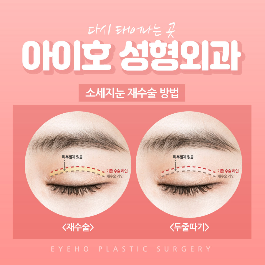 쌍꺼풀라인낮추기 두꺼운 소시지 재수술 흉터 개선 관련 이미지 3