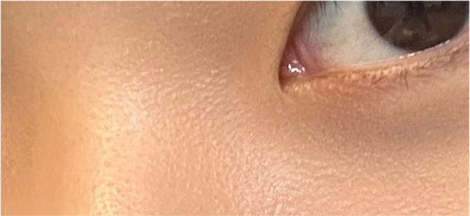 눈성형전후 디테일까지 꼼꼼하게 비교 관련 이미지 20