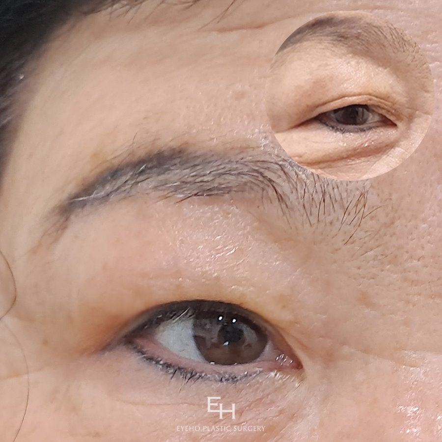 Upper Eyelid Surgery Review: Comparing Non-Incisional vs. Incisional Methods (Upper Eyelid Surgery Cost, Price, Precautions) image 13