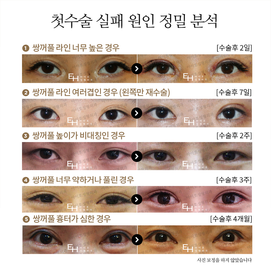Double Eyelid Revision Surgery Review: Be Sure to Check Carefully. image 2