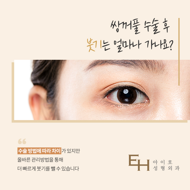 눈매교정가격 알아보고 있다면 관련 이미지 7