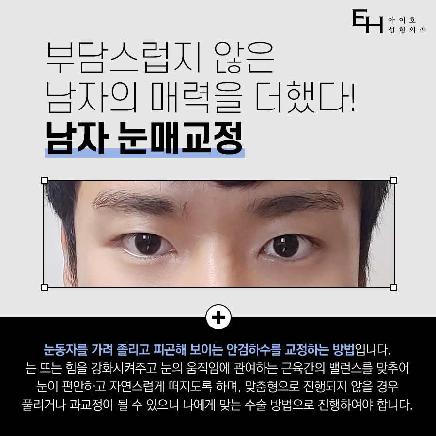 남자눈매교정가격 세심하게 따져봐야 관련 이미지 2