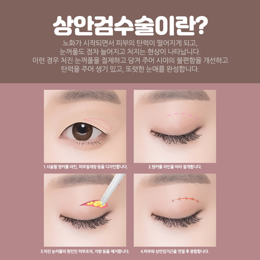 Upper Blepharoplasty for Drooping Eyes: Cost and Recovery Period image 3