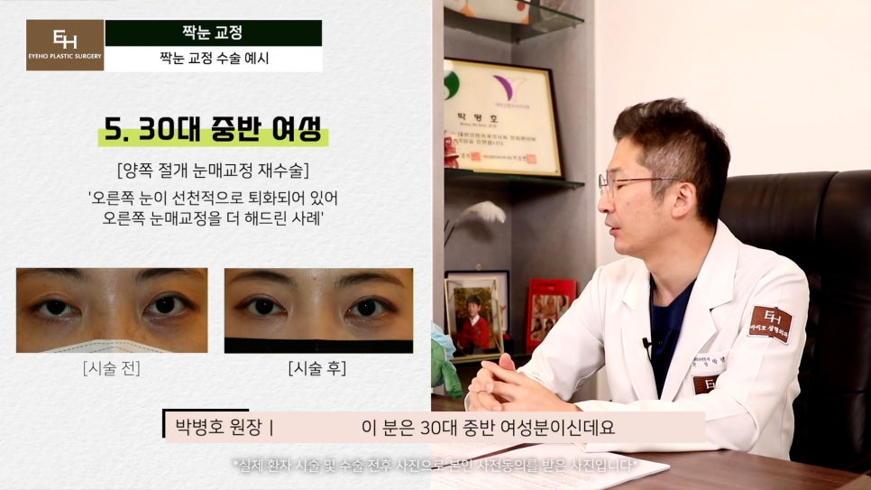 짝눈이 고민인데 양쪽 눈 수술하기 싫어요!! 한쪽 눈만 수술 가능!? 관련 이미지 13