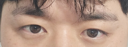 눈성형 종류 : 남자 눈성형 수술 후기 확인 관련 이미지 17