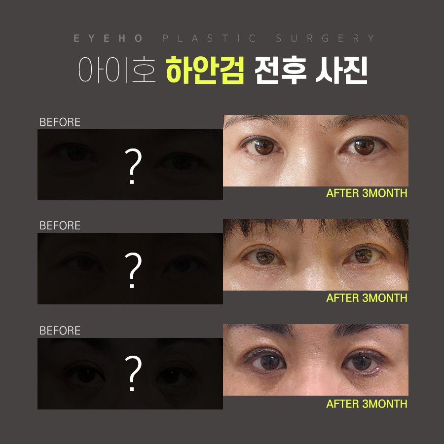 하안검 수술 후기 : 눈 밑 하안검 흉터 & 통증 / 잘하는곳 비교 분석 관련 이미지 4