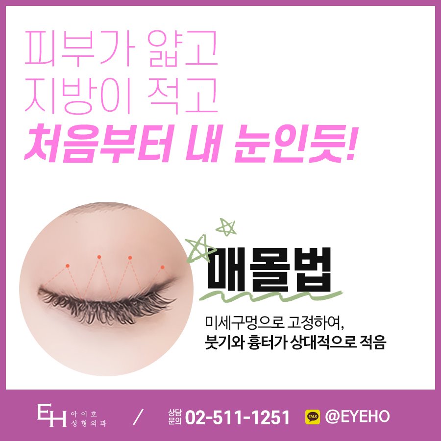 쌍수 매몰법 눈성형잘하는병원 후기 신중히 살핀다면 관련 이미지 2