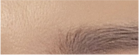 Brow Lift Cost and Brow Lift Review, Pain, and Precautions image 20