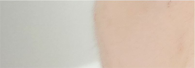 Effectively Achieving a Natural Look with Male Eye Surgery image 21