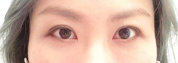 하안검수술 : 눈밑처짐수술 / 하안검 수술 후기, 비용, 회복기간, 부작용 관련 이미지 15