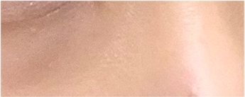 눈재수술비용 어떨때 개선해야 하나요? 관련 이미지 23