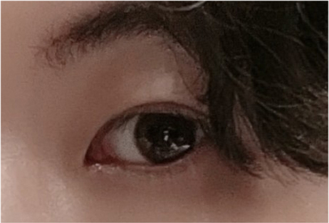 남자눈매교정전후 비교와 주의사항 관련 이미지 18
