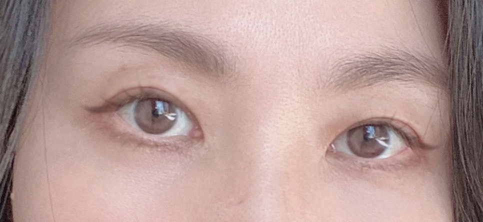 노화로 인한 상안검, 하안검 잘하는곳 찾는다면 관련 이미지 15