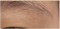 쌍꺼풀 수술 가격 및 후기 비교 분석 관련 이미지 19