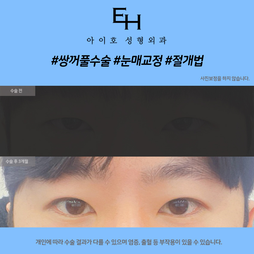 남자눈매교정전후 자연스러운 변화를 원한다면 관련 이미지 6