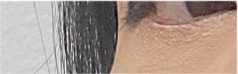 Brow Lift Cost and Brow Lift Review, Pain, and Precautions image 25
