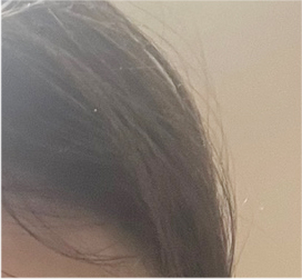 남자 눈매교정 가격 및 남자 눈매교정 전후 차이 비교 분석 관련 이미지 19