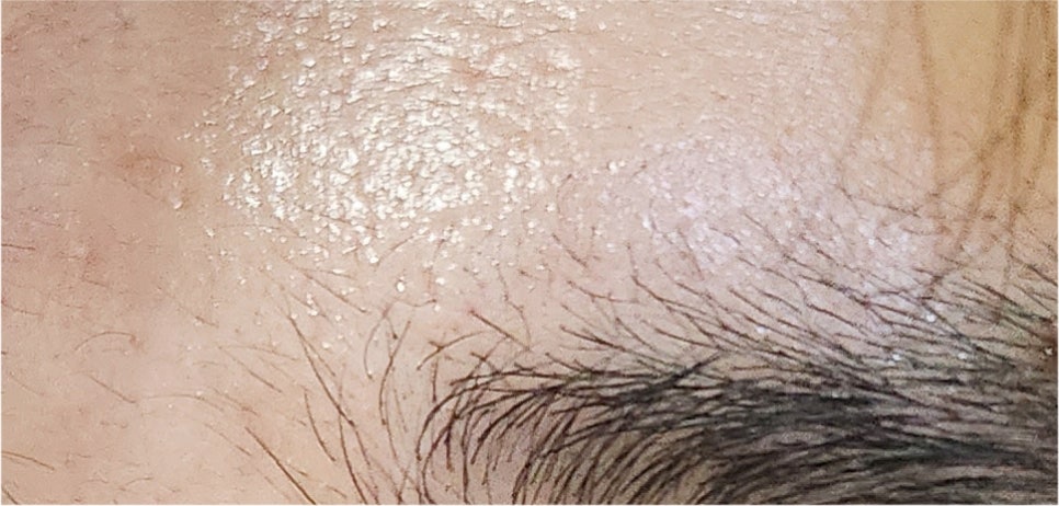 Effectively Achieving a Natural Look with Male Eye Surgery image 25