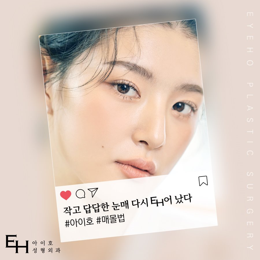 What to Consider for Satisfied Double Eyelid Burial Method Results image 1