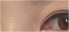 Brow Lift Cost and Brow Lift Review, Pain, and Precautions image 23