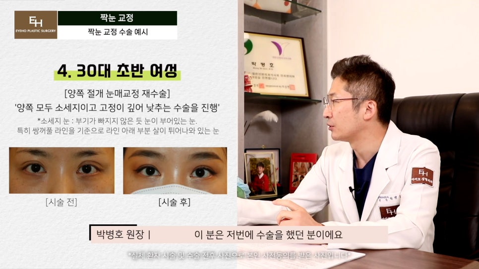 짝눈이 고민인데 양쪽 눈 수술하기 싫어요!! 한쪽 눈만 수술 가능!? 관련 이미지 12