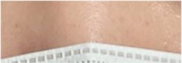 For a Natural Eye Shape Before and After Male Eye Surgery image 25