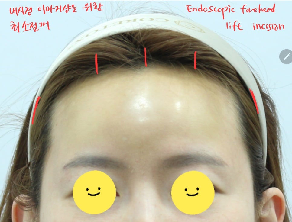 내시경을 이용한 최소절개 이마 보형물 제거 관련 이미지 4