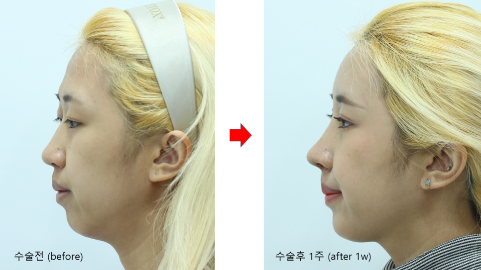 첫번째 코성형, 첫코성형, 20대 코성형 관련 이미지 11